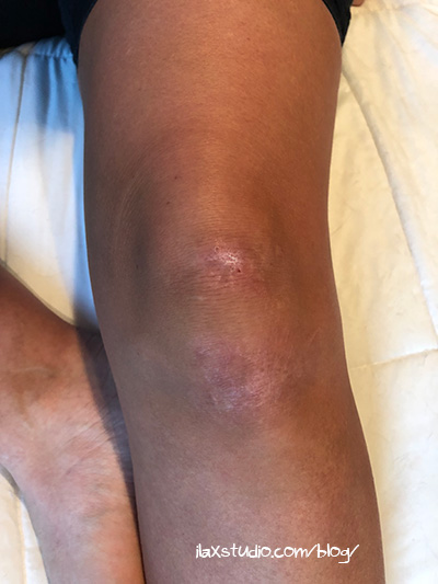 My knee is almost healed